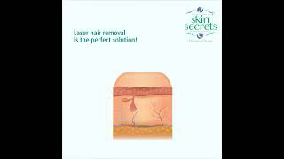 No More Shaving, Waxing, or Plucking! Laser Hair Removal at Skinsecrets