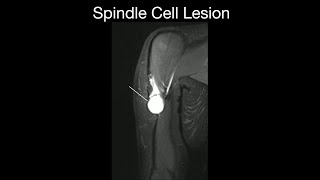 Spindle Cell Lesion