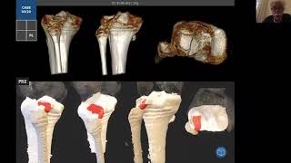 Fractura de Platillos tibiales