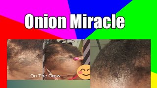 My ONION OIL APPLICATION  on 4c Fine Hair (Alopecia Defense)