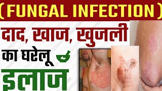 Fungal infection//fangas ko kaise thik kare //fungal infection kaise hataye // फंगल इंफेक्शन