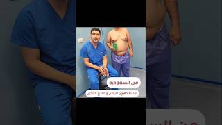 من #السعودية 🇸🇦 شفط دهون البطن وعلاج التثدى د محمد الهيتمى from KSA tummy and breast Liposuction