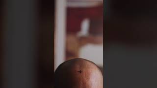 How We Mark the Scalp for Hair Transplants: A Quick Look!