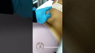 La mesoterapia es una excelente técnica para rebajar medidas, celulitis y flacidez #avefenixestetic