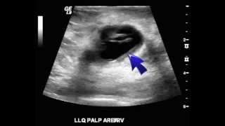 Ultrasound of abdomen revealing subcutaneous nodule