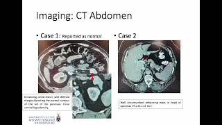 Insulinoma - from Diagnosis to Treatment