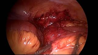 laparoscopic mesenteric mobilisation in sclerosing mesentritis   obstruction due to faeco bezoar in