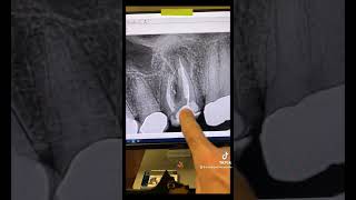 Root canal therapy of tooth #14.