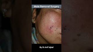 Mole Removal Surgery || By Dr.Arif Iqbal