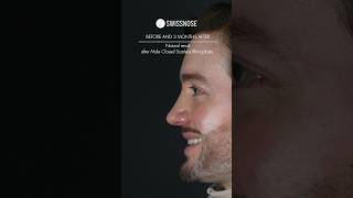 Before vs. 3 months after Male Closed Scarless Rhinoplasty | Dr. med. Simon Zimmermann