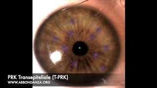 PRK Transepiteliale (T-PRK) - Dr. Marco Abbondanza