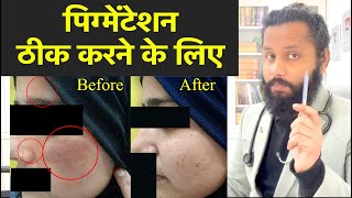 ✅ Pigmentation ठीक करने के लिए  - Dr Prateek chauhan