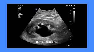 Large ureteral calculus with hydronephrosis, ultrasound imaging, prognosis and management