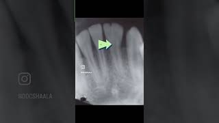 Fusion- #oralmedicine - #neetmds | #inicet |#inbde |#shorts