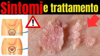 Attenzione! HPV sintomi nascosti che devi conoscere e come trattare!