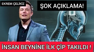 Şok Açıklama- İnsan Beynine İlk Çip Takıldı