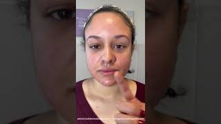 CHEMICAL PEELS for Acne Scars - Day 2