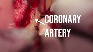 Coronary Artery (CABG surgery)