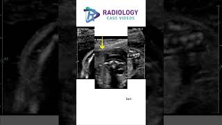 Diastematomyelia #Dr. Damayanthi #Dr. Chandana