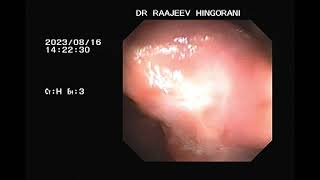 SRUS solitary rectal ulcer syndrome #gastronautclinic #gastro #endoscopy #colonoscopy #yt #viral