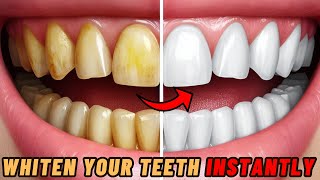 How To Whiten Teeth (Instantly) | Home Remedies For Teeth Whitening | DIY Teeth Whitening