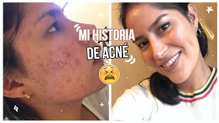 COMO CURÉ MI ACNE - MI EXPERIENCIA