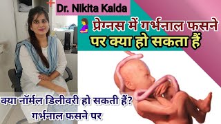 क्या नॉर्मल डिलीवरी हो सकती हैं? गर्भनाल फसने पर #pregnancytips #pregnancy #gynaecologist