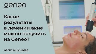 Какие результаты в лечении акне можно получить на Geneo?