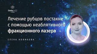 Лечение рубцов постакне с помощью неаблятивного фракционного лазера