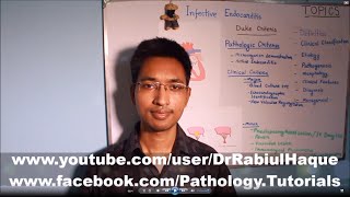 Infective Endocarditis Part 2 (HD)