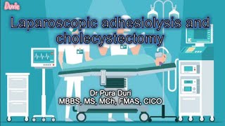 Laparoscopic Adhesiolysis and Cholecystectomy #laparoscopysurgery #cholecystitis #gallbladderstones