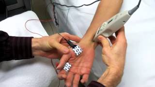 Median Motor Nerve Conduction Study