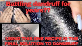 HOW TO USE THIS ONE RECIPE FOR THE TREATMENT OF DANDRUFF PERMANENTLY. #DandruffTreatment