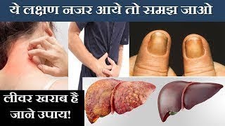 अगर ये लक्षण नज़र आएं तो तुरंत अपने लीवर की जाँच करवाएँ - Early Signs of Liver Damage