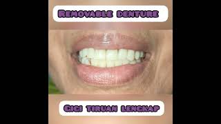 WDC_REMOVABLE  DENTURE | FULL EDENTULOUS | GIGI TIRUAN LENGKAP #shorts #dentist  #gigitiruan