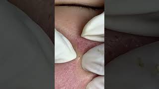 Big Cystic Acne Blackheads Extraction Blackheads & Milia, Whiteheads Removal Pimple Popping #shorts