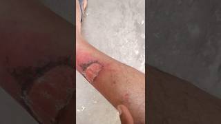 Accident se leg damage