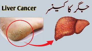 12 Signs Of liver Problem | Fatty Liver | jigar ki garmi ki alamat