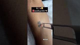 tattoo removal