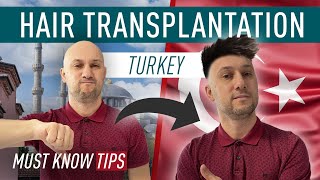 The Ultimate Guide to Hair Transplantation: What You Need to Know