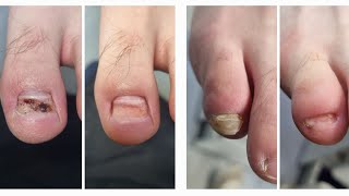 oczyszczenie paznokci po chodzeniu po górach #podopogotowie #toenails #toenailremoval