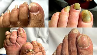 BEST Toenail Cutting Compilation! | 9 Minutes of Pure Nail Cutting | Dr. Kim, Kim Foot and Ankle