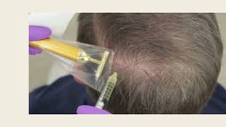 Hair Restoration with PRP therapy