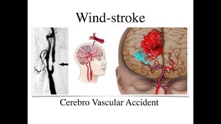 Session 1 -Introduction -Acupuncture & Wind Stroke , Apoplexy , Paralysis ,Cerebro Vascular Accident