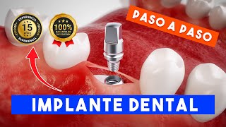 ✅ Implantes Dentales en Lima Perú 🔴 Paso a Paso