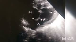 Double inlet left ventricle(DILV) with hypoplastic  RV