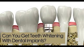 Can You Get Teeth Whitening With Dental Implants?