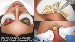 ASMR 뭉치고 오래된 속눈썹 연장 제거 & 왕 다래끼 치료 애니메이션 | Lash Deep Cleaning & Stye Treatment Animation