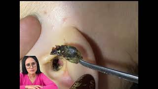 satisfying relaxing video earwax removal relaxation.