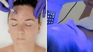 Acne & Acne Scarring Facial with Microneedling & Dermaplaning | What Me Work | Gemma Plumb